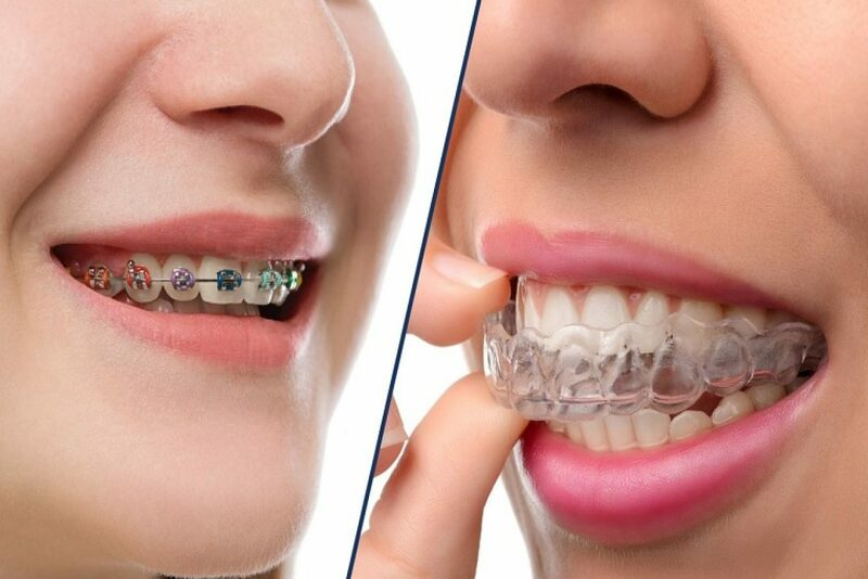 Niềng răng Invisalign khắc phục được những nhược điểm mà niềng răng mắc cài để lại